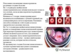 Последствия после химиотерапии при раке шейки матки 4 стадии