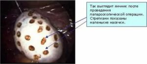 Когда начинаются месячные после лапароскопии поликистоза яичников