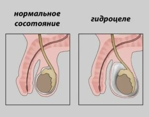 Может ли водянка яичка влиять на потенцию