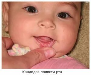 Лечение молочницы у грудничков в промежности