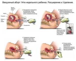 Когда лучше делать чистку матки до месячных или после