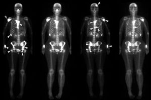 Сцинтиграфия костей скелета при раке молочной железы