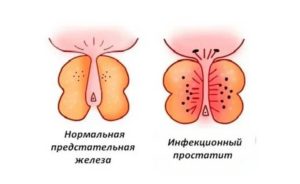 Если у партнера инфекционный простатит