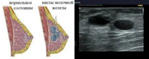 Что такое киста молочной железы и как ее лечить у ребенка