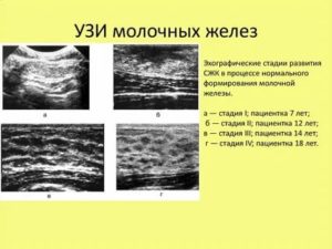 Морфотипы по узи молочной железы