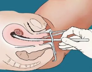 Когда лучше делать чистку матки до месячных или после