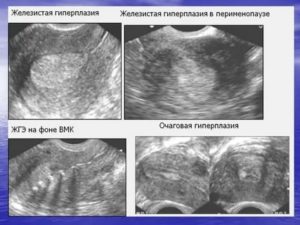 Может ли гиперплазия эндометрия пройти сама в постменопаузе