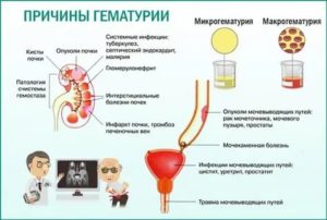 Лечение антибиотиками при гематурии у мужчин