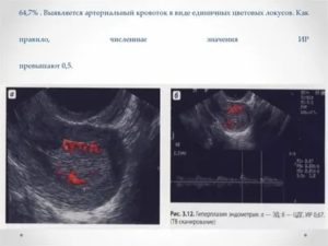 Узи с кровотоком в эндометрии для чего делают