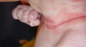 Помогает ли зеленка при молочнице у грудничка