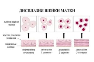 Какими препаратами лечить дисплазию шейки матки 1 степени