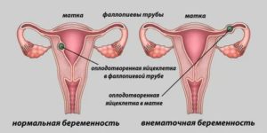 Может ли быть внематочная беременность при менопаузе