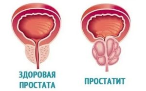 Будь здоров простата