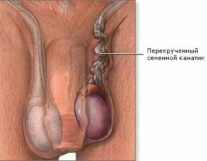 Опухоль и боли в половом члене