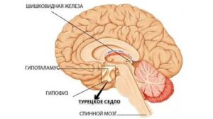 Турецкое седло в головном мозге и бесплодие