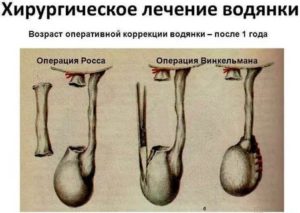Водянка яичка мочегонные препараты