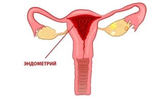 Как при гиперплазии проходит менструация