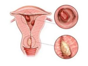 Если не лечить миому эндометриоз и полипы что может быть