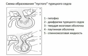 Турецкое седло в головном мозге и бесплодие