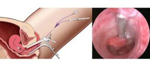 Гистероскопия мва эндометрия что это