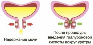 Пластику наружного отверстия уретры гелем гиалуроновой кислоты