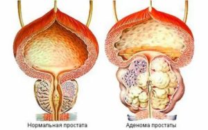 Аденома простаты тамсол