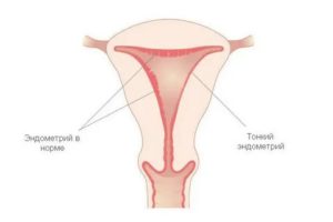 Тонкий эндометрий может ли быть причиной бесплодия