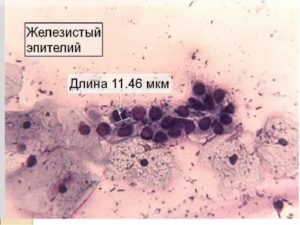 Пролиферация цилиндрического эпителия шейки матки это рак