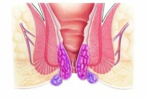 Может ли перед месячными обостряться геморрой