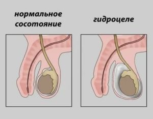 Почему после долгой эрекции болят яички