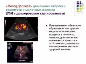 Узи молочных желез с допплеровским исследованием что это такое