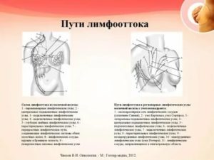 Лимфодиссекция при раке молочной железы это