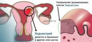 Миома матки и гиперплазия эндометрия при климаксе