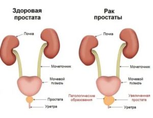 Будь здоров простата