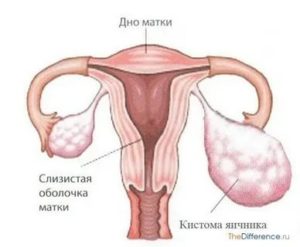 Чем отличается киста яичника от кистомы яичника