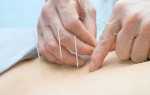 Можно ли делать иглоукалывание при эндометриозе