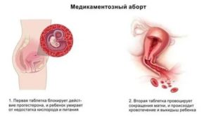 Прерывание беременности при молочнице