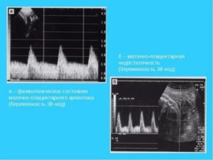 Маточно плацентарный кровоток при узи
