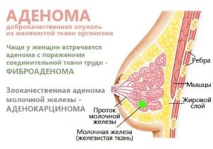 Что такое аденома и киста молочной железы