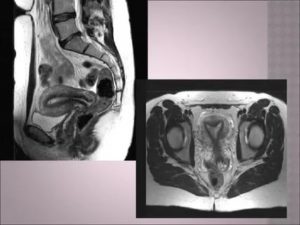 Что может показать мрт в гинекологии