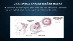 Психосоматика заболевания рака шейки матки