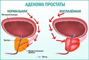 Герпес при аденоме простаты