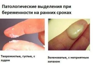 Молочница на ранних сроках беременности до задержки лечение