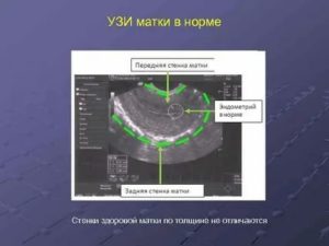 Передняя и задняя стенка матки на узи