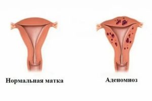 Эндометриоз культи шейки матки симптомы и