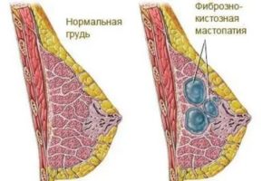 Как часто фиброзно-кистозная мастопатия переходит в рак