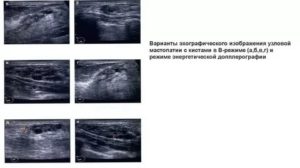 Очаговый аденоз молочной железы на узи