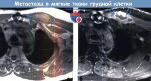 Метастазы в мягкие ткани при раке молочной железы