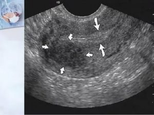 Недостаточность эндометрия по узи