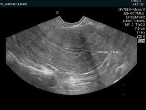 Может ли быть ошибка на узи при миоме матки